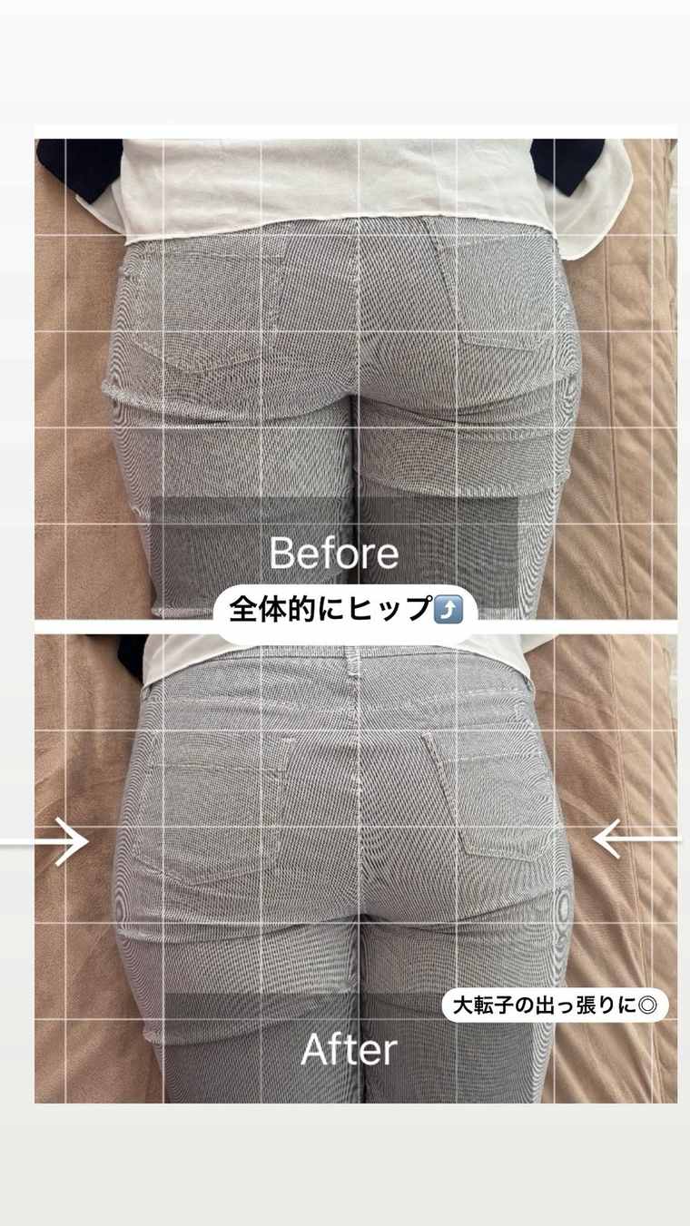施術前と施術後の後ろ姿の比較